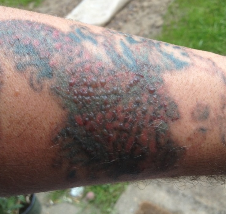 Couple of weeks after Grants first session | Laser Tattoo Removal